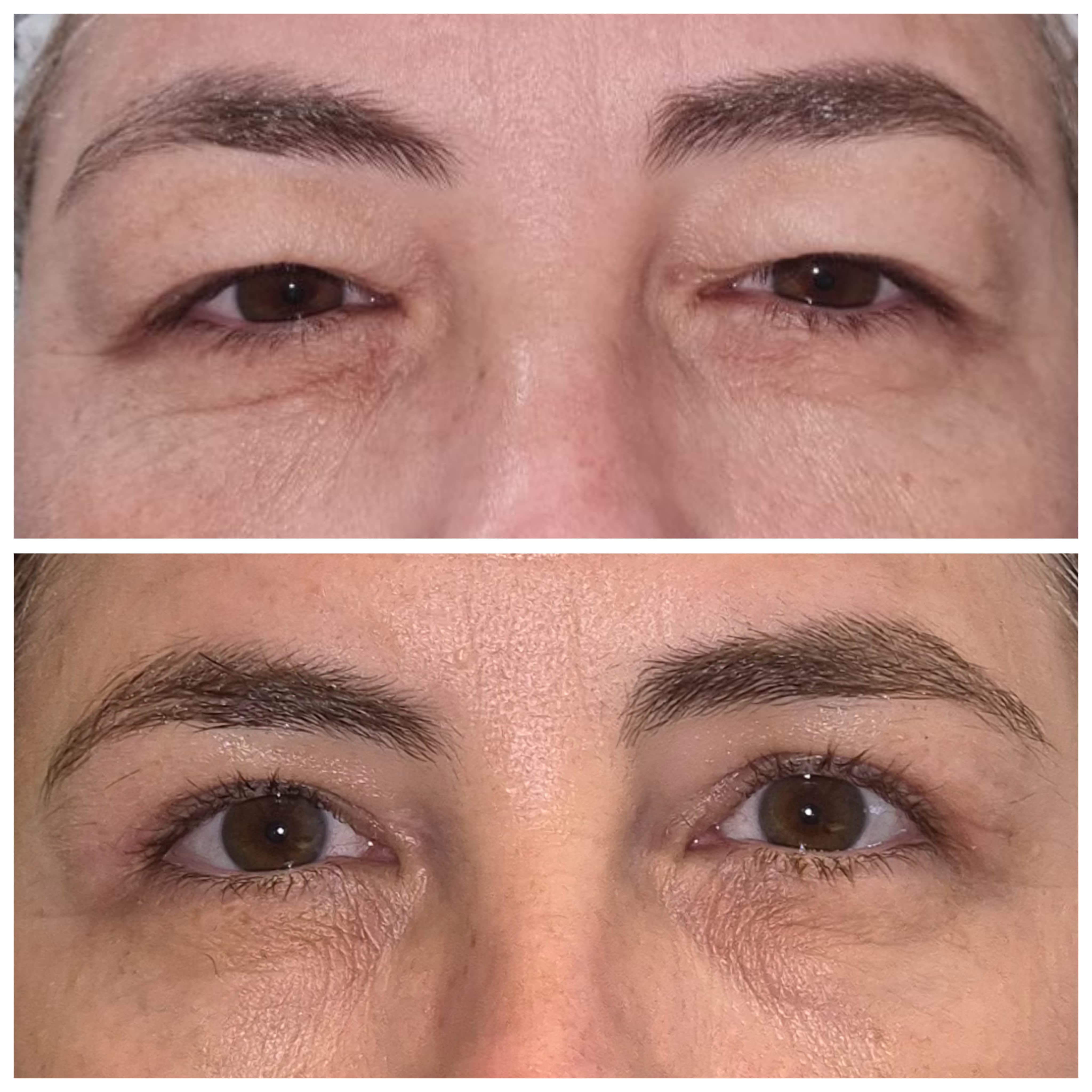 Antes e depois de blefaroplastia 11